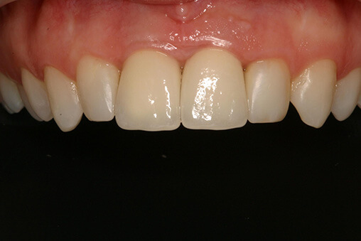 After image