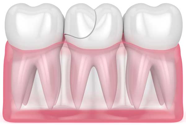 fusion influenza komfortabel Knækket tand eller flækket tand: hvad gør jeg? Behandling knækket tand