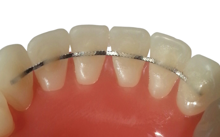 En metaltråd sidder på bagsiden af de forreste tænder og holder dem på plads efter Invisalign