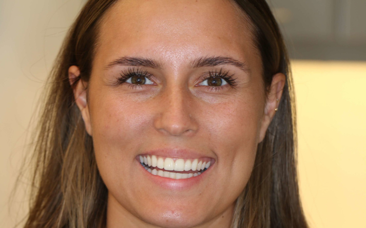 En kvindes smil efter behandling med en gennemsigtig tandbøjle Invisalign.