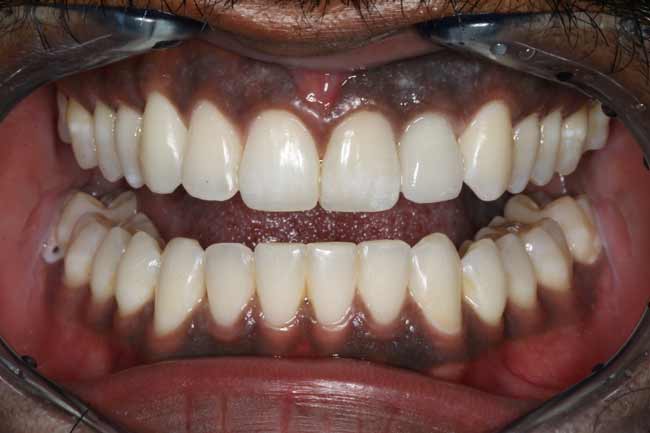 tænder efter implantater
