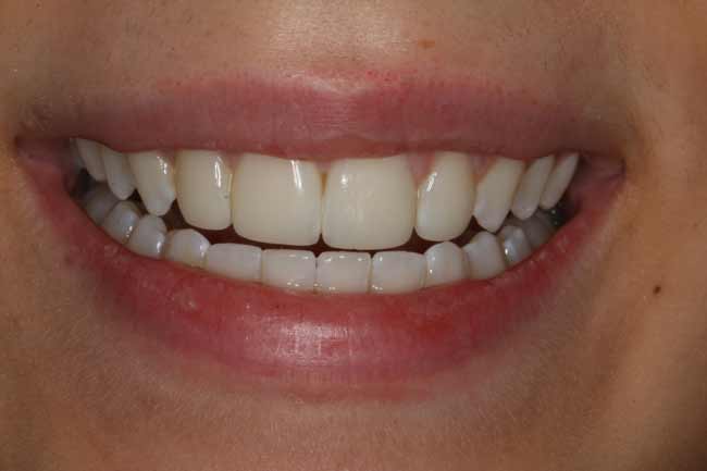 tænder efter kosmetisk behandling
