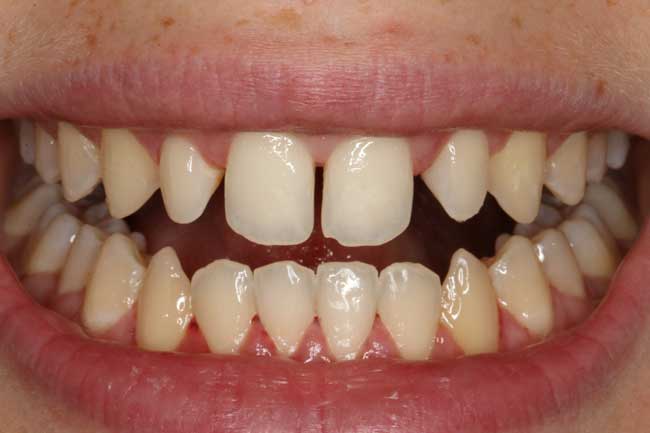 tænder før kosmetisk behandling