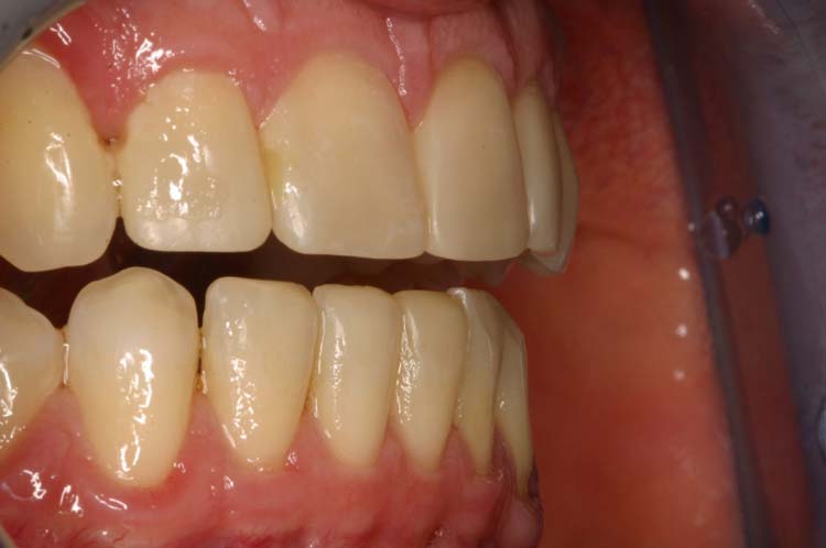 After image