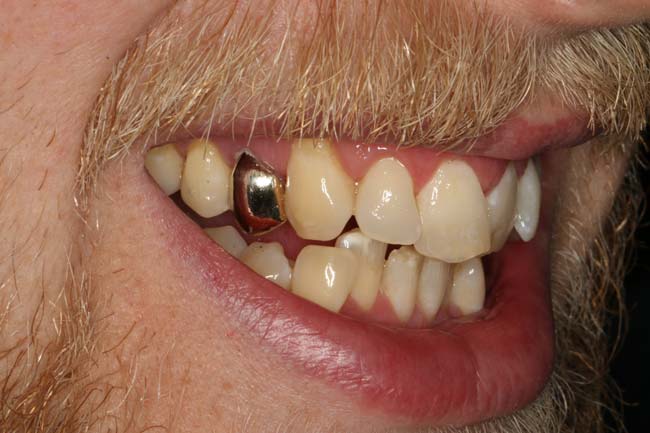 After image