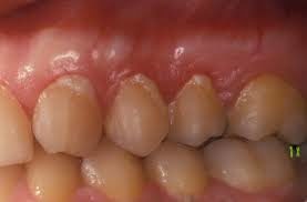 Eksempel på skadelige (hvide) bakteriebelægninger (plak) langs tandkødskanten
