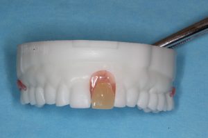 Protesen fremstilles på en model af dine tænder