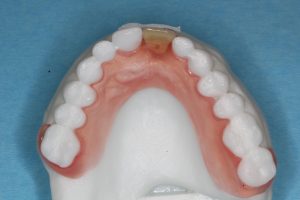 Protesen griber om tænderne indefra
