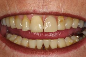 Den kunstige tand smelter fint sammen med de naturlige tænder
