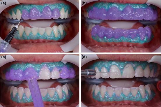 Blegning foretaget på tandklinik. Tandkødet beskyttet med blå isolering.
