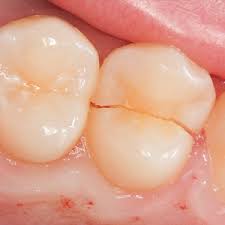 Længdegående revne – tanden kan ikke reddes
