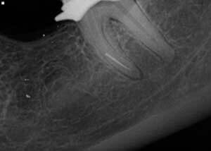 Røntgenbillede af knækket rodfil i tandrod