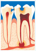tand med rodspidsbetændelse
