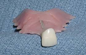 Store dele af ganen er dækket selvom den kun erstatter én tand