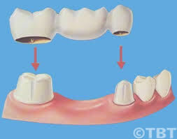 2 beslibede tænder støtter brokonstruktionen, som erstatter én manglende kindtand.
