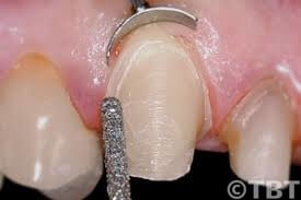 Tænderne beslibes med diamantbelagte tandbor