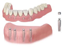 Normalt er 2 implantater nok