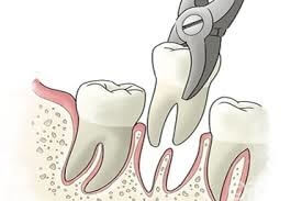 Der findes specialtænger for hver enkelt tand