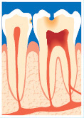 Hullet når dybt ind i tanden og nerven er betændt – skal rodbehandles