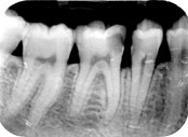 Røntgenbillede af tand inden rodbehandling.