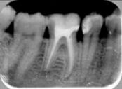Røntgenbillede af tand efter rodbehandling og rodfyldning