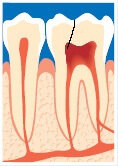 Revne når dybt ind i tanden og nerven er betændt – skal rodbehandles