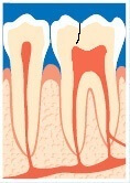 Illustration af revne midt i tanden tæt på tandnerven