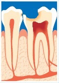 Tanden er knækket grundet det store hul. Tandnerven er meget udsat.