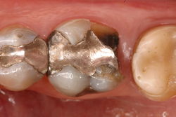 Tand med gammel sølvplombe er knækket
