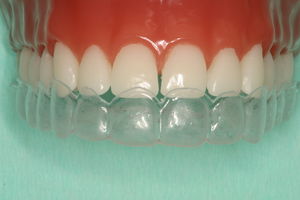 Blegeskinnen fremstilles på vores laboratorie og passer præcist til dine tænder.