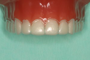 Blegeskinnen er stort set usynlig, når den sidder på tænderne, og kan derfor anvendes på alle tidspunkter.