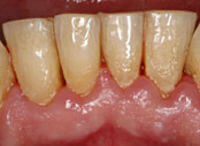 Paradentose rammer ca. 25 % af befolkningen i varierende grad, og skyldes ‘usynlige’ bakteriebelægninger pga. mangelfuld renhold. Tænderne sidder fast i knoglen – ikke i tandkødet! Paradentose nedbryder knoglen omkring tænderne, så de kan blive løse og i værste fald mistes. Blødende tandkød kan være et tegn på paradentose. Her ses paradentose med bakteriebelægninger og tandkødsbetændelse.