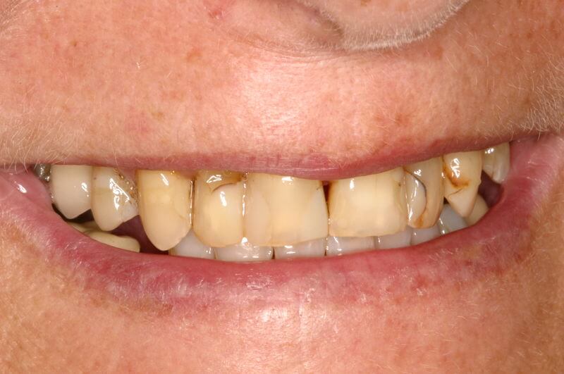 Misfarvede tænder og store fyldninger