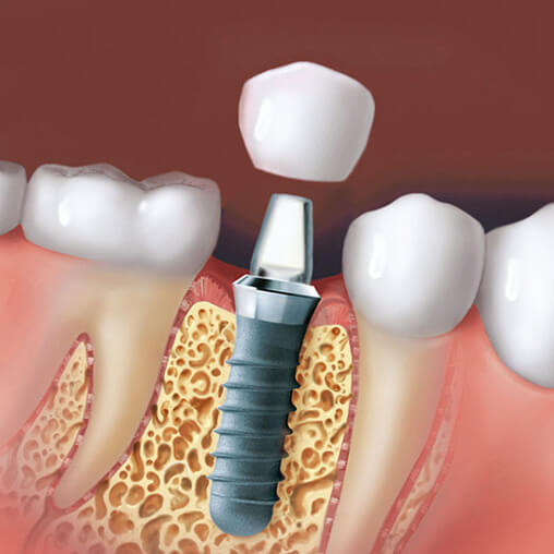 tænder før implantater