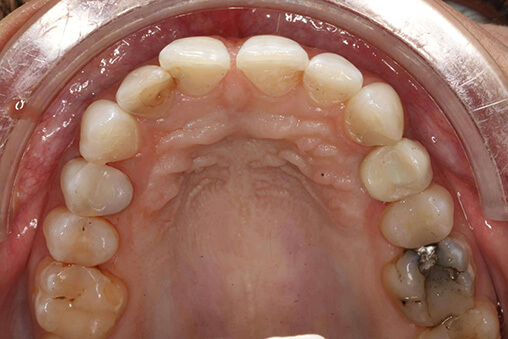 tænder efter implantater