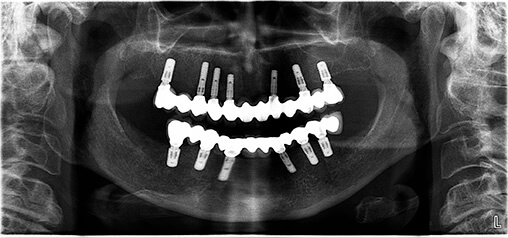 tænder efter implantater