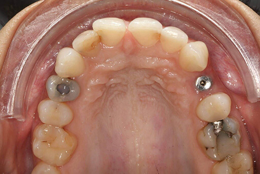 tænder før implantater