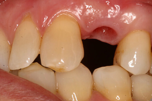 tænder før implantater